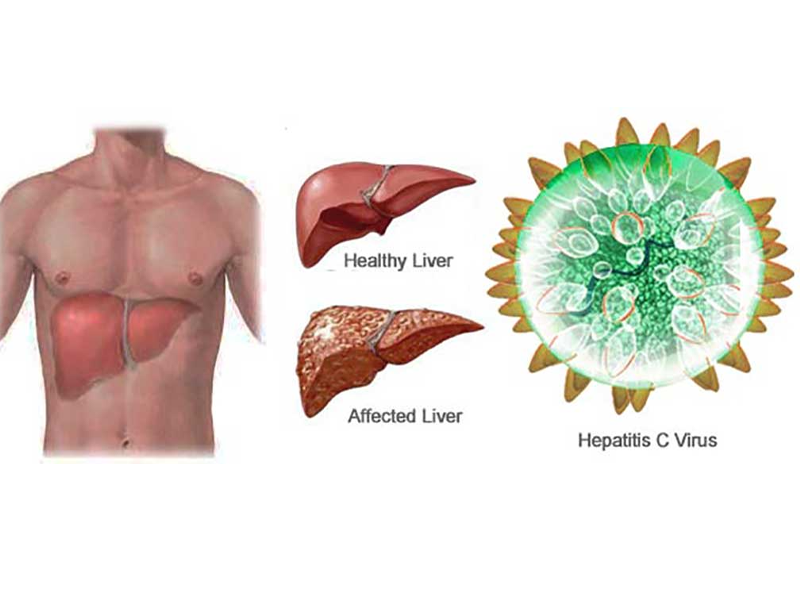 khong-biet-mac-viem-gan-virus-c-du-hien-mau-suot-10-nam