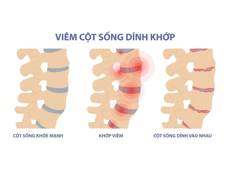 phat-hien-viem-cot-song-dinh-khop-sau-20-nam-chan-doan-nham-benh