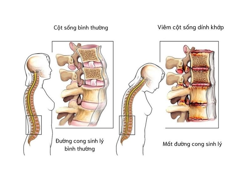 toa-dam-nhan-dien-som-benh-viem-khop-cot-song-va-vai-tro-cua-chan-doan-hinh-anh
