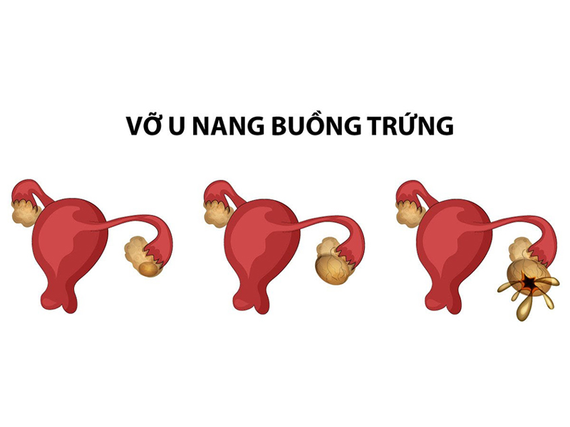 vo-u-buong-trung-to-nhu-thai-9-thang-sau-khi-lac-vong