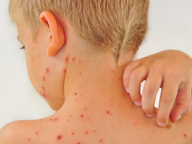 ban-soi-co-ngua-khong-nhung-dieu-can-biet-de-cham-soc-nguoi-bi-soi-hieu-qua