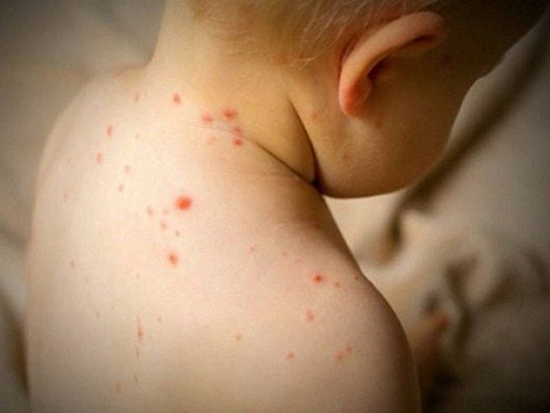 benh-soi-o-tre-em-nhung-dieu-phu-huynh-can-biet-de-bao-ve-con-yeu-khoi-can-benh-nguy-hiem